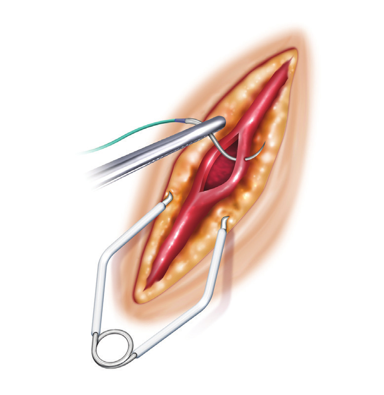 Клипсы-ретракторы для коронарной артерии DLP