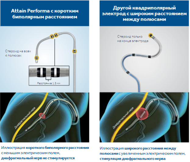 Attain Performa - Электрод для стимуляции в кардиальной вене